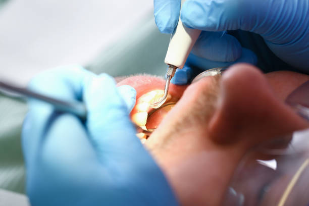 Best Emergency Wisdom Teeth Removal in Millport, AL