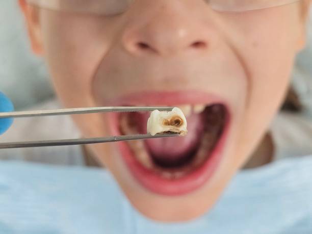 Best Emergency Wisdom Teeth Removal in Millport, AL